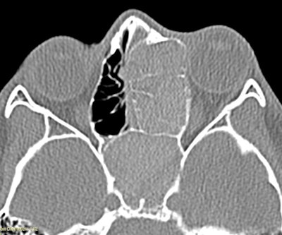 Figure 1. CT demonstrating the unilateral expansile disease process, which ultimately was determined as AFRS.