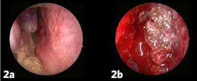 Figure 2a and b. AFRS often presents with substantial polyp burden and dense eosinophilic mucin with a “peanut butter” consistency.