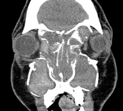 Figure 3. CT demonstrating classic findings of heterogeneous sinus opacification with areas of hyperattenuation and metallic-type “double densities” on soft tissue window causing expansile changes to the paranasal sinuses and leading to expansion and erosion of the bony orbit, skull base, and facial skeleton.