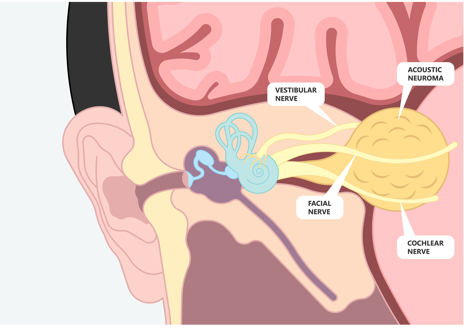 Contemporary Management of Vestibular Schwannoma | AAO-HNS Bulletin