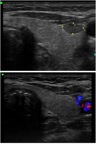 Figure 1. Intrathyroid left inferior parathyroid adenoma with polar blood flow pattern.
