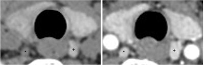 Figure 2. Axial CT non-contrast (left) and arterial phase contrast (right) demonstrating left thyroid tubercle (+) and right superior parathyroid adenoma (*). The parathyroid adenoma is hypodense relative to the thyroid gland on the non-contrast image and avidly enhances on the arterial phase contrast image while the thyroid tubercle is isodense to the thyroid on the non-contrast image.