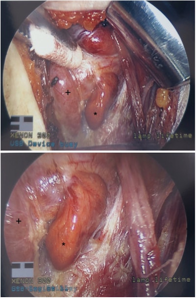 Figure 3. Minimally invasive left interior parathyroidectomy. Left Inferior parathyroid adenoma (*) and left thyroid lobe (+).