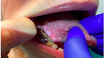 Oral Leukoplakia