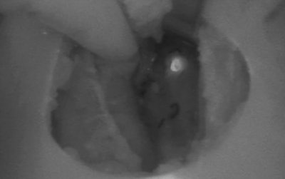 A near infrared camera system demonstrates the relatively bright autofluorescence of a parathyroid gland against the thyroid lobe.