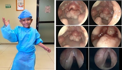 Patient with recurrent laryngeal papillomatosis treated with multiple surgeries and systemic Bevacizumab.