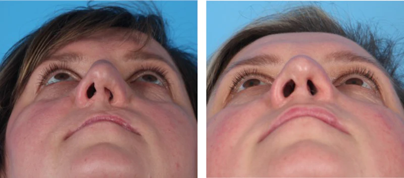 Completing The Care Cycle In The Adult Patient With Cleft Lip Palate completing-the-care-cycle-in-the-adult-patient-with-cleft-lip-palate