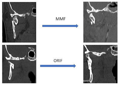 Figure 1. Comparison of bony reduction before and after closed reduction with MMF (top row) and ORIF treatment (bottom row). Note that following MMF treatment, the bony segments remain somewhat displaced despite establishing dental occlusion. In the ORIF treatment, mandibular height has been restored and the fracture has been fully reduced.