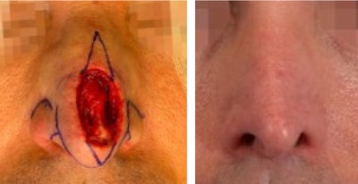 Figure 1. Nasal tip and dorsum defect closed primarily along its narrowest width. Primary closure is used here to create a narrow a wide nasal tip.