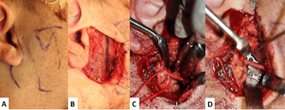 Figure 2. External approach for ORIF of a right subcondylar fracture. Pre-auricular skin incision and surface markings of the mandible are shown (A). After elevating the skin flap, a separate incision in the parotidomasseteric fascia is marked (B). Exposure of the fractured segments through the parotid gland is shown in C with a red vessel loop marking a buccal branch of the facial nerve. After bony reduction and plating the fracture is stabilized with a dynamic 3D plate (D).