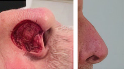 Figure 3. A full thickness skin graft from the supraclavicular region was used to reconstruct this nasal ala defect. It would also be reasonable to consider placing an alar rim graft to prevent alar notching given the defect's proximity to the alar rim.