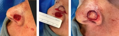 Figure 4. An auricular composite graft was used to reconstruct a partial thickness nasal ala defect abutting the nostril margin. Composite grafts may be useful for defects < 1.5 cm.