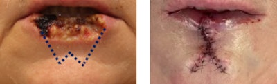 Figure 5. Lower lip cutaneous defect reconstructed with a wedge resection, W plasty, and imbrication of the orbicularis oris muscle to provide additional lip fullness.