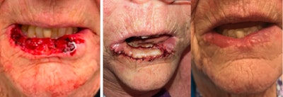 Figure 6. Lower lip cutaneous defect reconstructed with a FAMM flap. The addition of the buccinator muscle within the flap adds bulk to the lip.