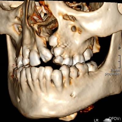 Figure 3. 3-D CT scan of adult patient with unilateral cleft showing unrepaired alveolar cleft and dental malocclusion that was never addressed as a child.