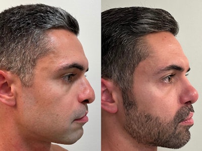 Figure 1. Adult patient with cleft lip nasal deformity before and after definitive septorhinoplasty.