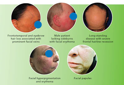 Grouping of clinical photos showing FFA symptoms