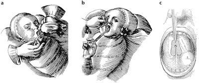 Figure 1. Woodcut from the 17th century describing surgical technique for frenotomy. Obladen, Michael. 'Much ado about nothing: two millenia of controversy on tongue-tie.' Neonatology 97, no. 2 (2010): 83-89. Reproduced with permission from S. Karger AG, Basel, Switzerland. Woodcuts showing the operative techniques of Fabricius in 1620 (a) [‘the tongue is held with a handkerchief and the band loosened with a falciform knifelet’] and Scultertus in 1666 (b) ['how the surgeon lifts the tongue with a silver instrument and dissects the attached band with a small sharp scissors']. (c) Ranula (grenouillette) with Petit's spatula on frenulum.