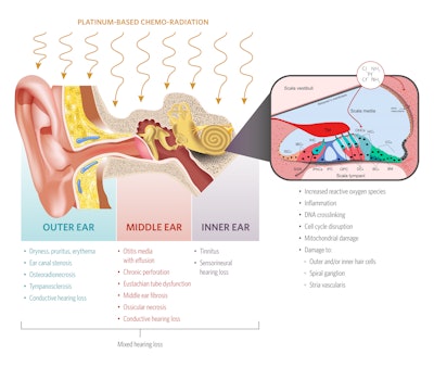 Figure 1. Diagram of the key mechanisms responsible for hearing loss in the oncologic population. The close-up image illustrates the primary impact of cisplatin on the inner ear. Abbreviations: inner sulcus cell (ISC), inner border cell (IBC), inner hair cell (IHC), tectorial membrane (TM), outer hair cell (OHC), Hensen’s cell (HC), Claudius’ cell (CC), basilar membrane (BM), Boettcher’s cell (BC), Deiters’ cell (i.e., outer phalangeal cell) (DC), outer pillar cell (OPC), inner pillar cell (IPC), inner phalangeal cell (IphC), piral ganglion neuron in the spiral canal of Rosenthal (SGN).