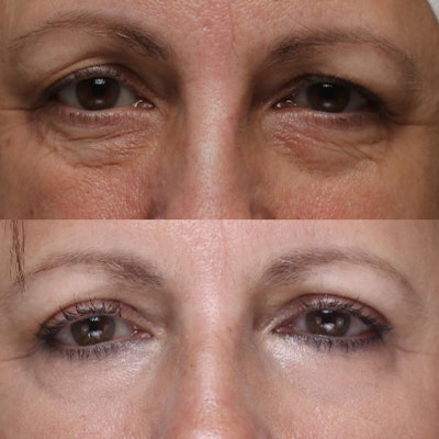 This photo shows a top and bottom comparison of a cosmetic eye lift on a woman.