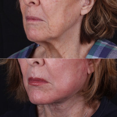 Closeup comparison photo of cosmetic work around a woman's mouth.