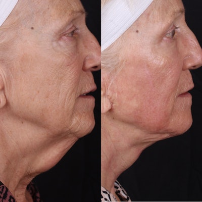 Side-by-side photo of an older woman's face before and after a face lift.