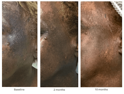 This is a photo of a patient with skin of color who is being treated for a dermatology pigmentary disorder.