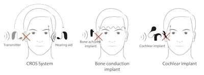 Figure 2. Comparison of CROS amplification versus bone conduction and cochlear implants.