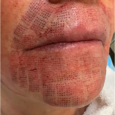 Immediately following an Ellacor treatment of the perioral area. Photo courtesy of Morgan Murphrey, MD, MS, FAAD.