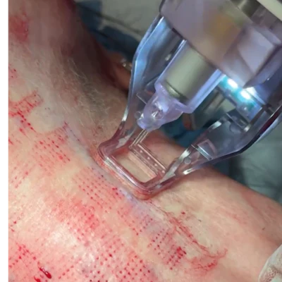 An Ellacor treatment. Photo courtesy of Morgan Murphrey, MD, MS, FAAD.