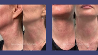 After two treatments with Hyperdilute CaHA (1:4), 8 weeks apart.