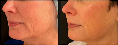 Before and 30 days after an Ellacor treatment. Photo courtesy of Mathew Avram, MD, JD, FAAD.