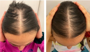 Before and after photos of a patient with hair loss. Patient received FoLix treatment.