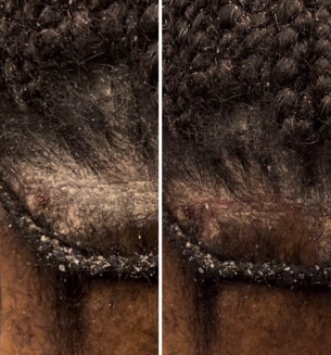 Before and after photos of a patient with scalp psoriasis tread. Patient received four hydradermabrasion treatments, one week apart.