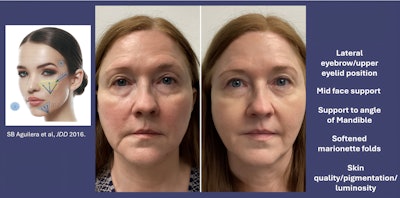 Supraperiosteal Injection Technique using PLLA-SCA (After 1 treatment - 2 vials).