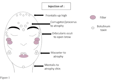 Male-to-female gender affirmation injectable example.