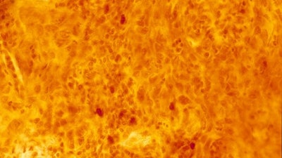 Figure 2. Pictomicrograph of former President Grant's oropharyngeal squamous cell carcinoma. Reproduced with permission and courtesy of the Otis Historical Archives of the National Museum of Health and Medicine.3