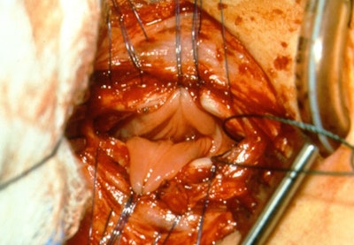 Figure 1. Exposure of esophageal mucosa through an anterior tracheotomy overlying the TEF.