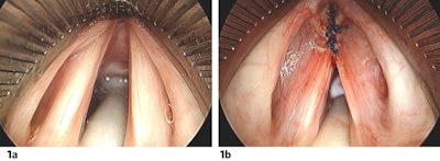 Figure 1a and 1b. Intraoperative direct laryngoscopy before (a) and after (b) endoscopic feminization laryngoplasty.
