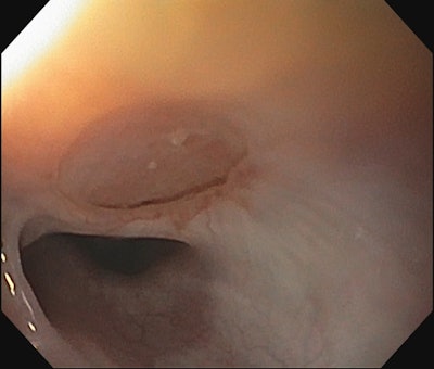 Figure 2. EGD following repair of TEF using pedicled tracheal wall and slide tracheoplasty.