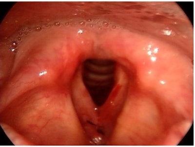 Figure 2. Postoperative day 1 transnasal laryngoscopy showing an expected amount of edema and ecchymoses following endoscopic feminization laryngoplasty.