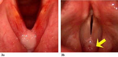 Figure 3a and 3b. Typical presence of granulation tissue overlying the surgical web and sutures at POD 5 (a). Note that much of the edema and ecchymoses seen on POD 1 has resolved. Persisting granulation tissue is again noted on POD 30 (b).