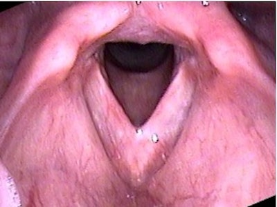 Figure 4. 12-month status post feminization laryngoplasty. Note: neither granulation tissue nor sutures are seen. The surgical web is mature.