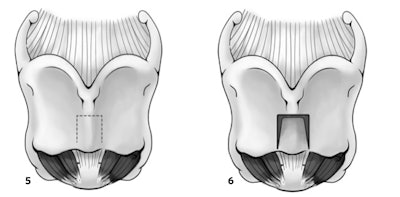 Figure 5 and 6. Author’s technique for transcervical masculinization laryngoplasty preserving the projection of the thyroid notch.