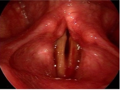 Figure 7. Postoperative day 1 laryngoscopy depicting an average degree of edema and ecchymoses following masculinization laryngoplasty.
