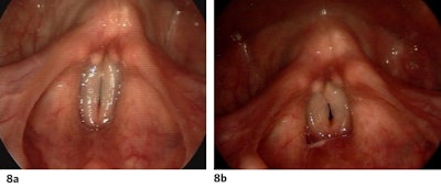 Figure 8a and 8b. Pre- (a) and 9-months post (b) masculinization laryngoplasty. Note the degree of tension released from the vocal folds.