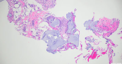 A sample Kodachrome image that attendees can identify during the ‘Test Your Knowledge’ portion of Monday’s dermatopathology session. Be there to find out if you got it right!