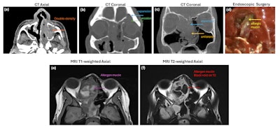 Figure 1. Radiological features of AFRS from CT (1a-c), endoscopic surgery (1d) and MRI imaging (1e-f).