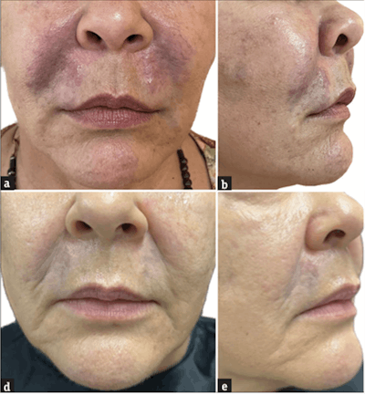 Top photos (a, b) portray nodules and erythema in the nasolabial fold as a result of permanent filler injections. Bottom photos (c, d) demonstrate results after treatment with JAK inhibitors.