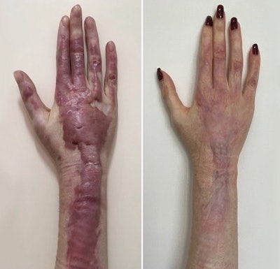 Natural results (right) obtained after treating hypertrophic scars on a burned patient using the ASAP nonsurgical sequential algorithm.